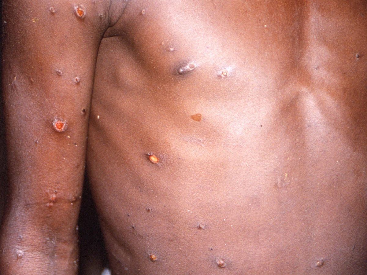 Monkeypox virus