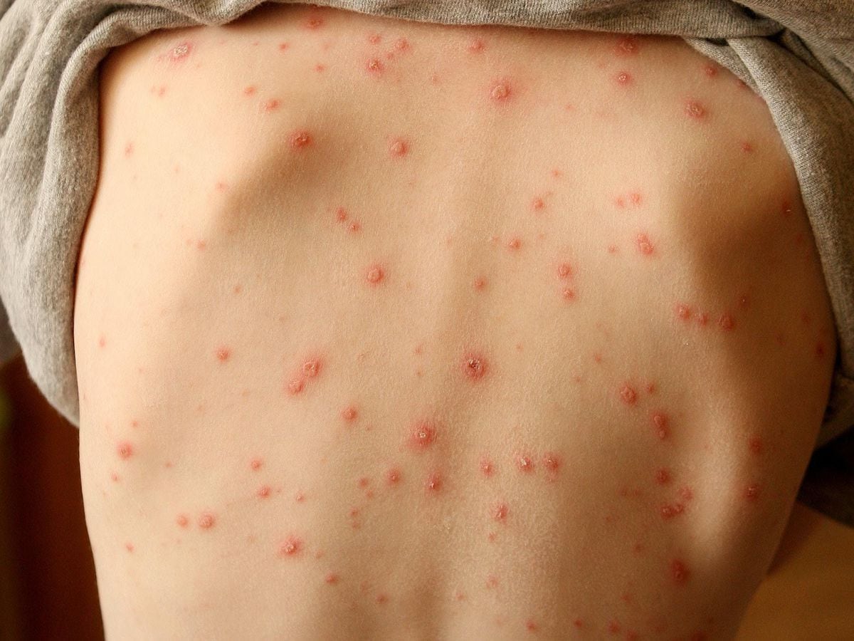 Skin Rash Should Be Considered Key Symptom Of Coronavirus Say   GNVBJC5LRVB4VDWSZHGJCTVQ4U 