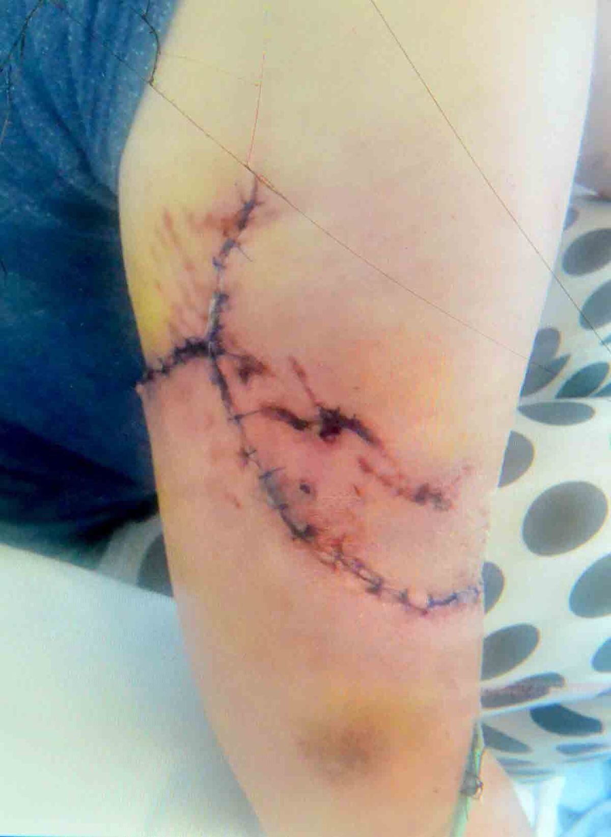 'The flesh was coming out of my arm': Dog attack victim left needing