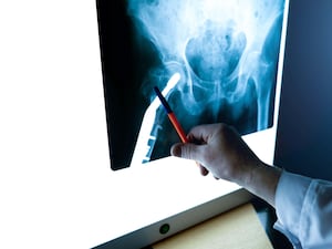 A radiologist examines an X-ray of the hip joint in close-up It is estimated that a third of females and 17% of males over 80 will suffer a hip fracture