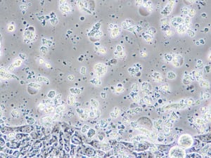 Microscope view of bowel cancer cells in tissue culture