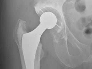 An X-ray image of a hip replacement