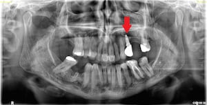 A failing upper left implant which fell out