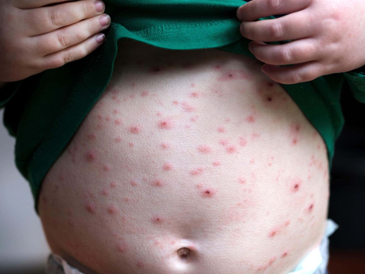 introducing-routine-chickenpox-jabs-for-children-could-end-risky-pox